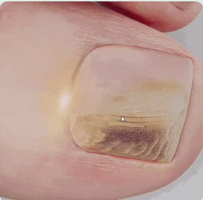 PureNail Nagelbehandeling Tar bort 98 % av nagelsvampen på 7 dagar!